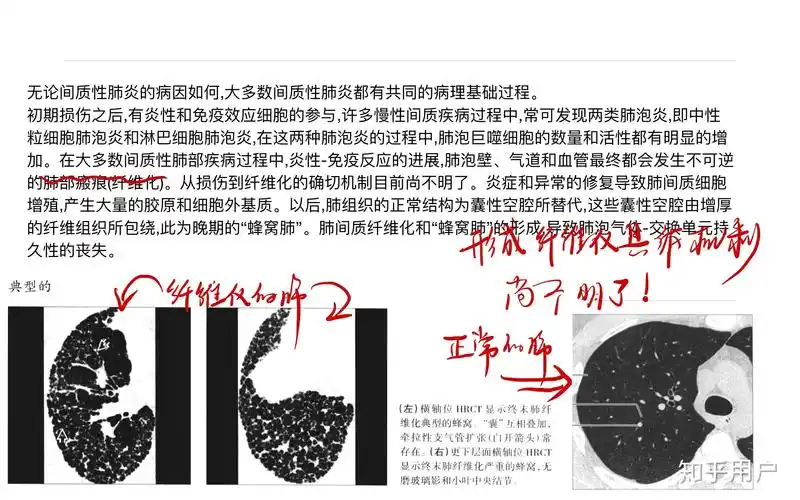 为什么肺会纤维化纤维化是什么样的状态有图片吗