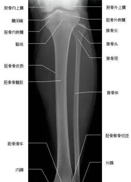胫腓骨正位—x线