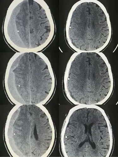 老年人头部外伤后需警惕慢性硬膜下血肿的发生