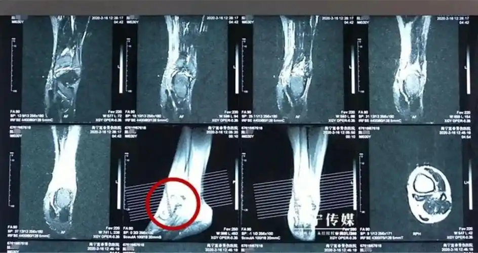 【科普】男子崴了脚不当回事,半年后,可怕的一幕出现了