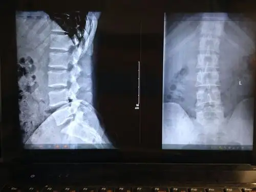 扁平足会引起腰肌劳损吗?