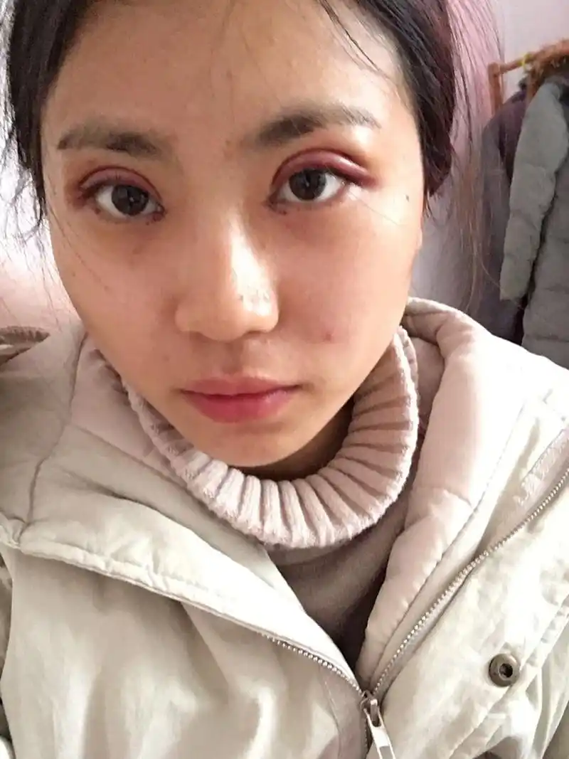 双眼皮手术第二天 图1是昨天刚做完 图2是刚刚拍的 早上起来的时候比