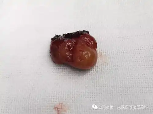 中老年妇女小心尿道口息肉_尿道息肉_尿道息肉疾病介绍 - 好大夫在线