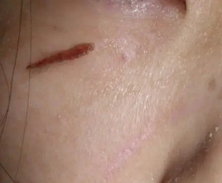 脸被人抓破 结痂后有红印啊! 急求! 有图