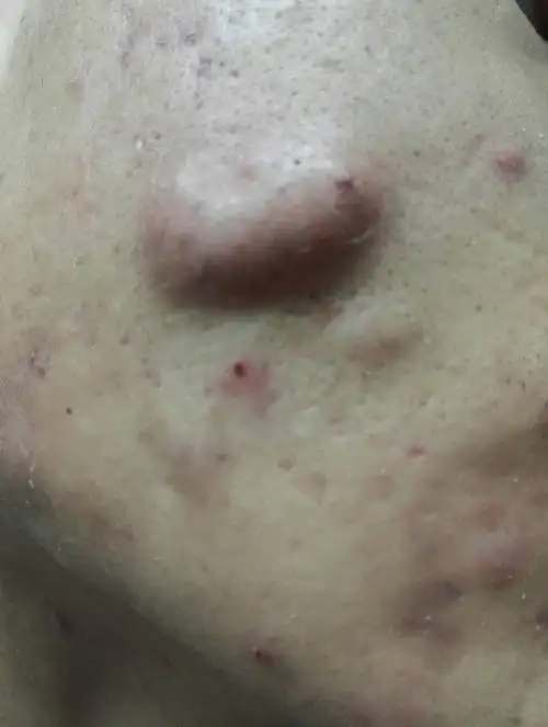 脸上老是起这样的脓包怎么办?
