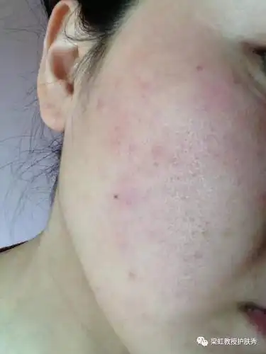 病人主述:我现在皮肤面部潮红反复发作,不耐受,超级敏感不能彩妆,过敏