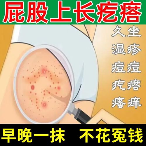 屁股上有疙瘩 久坐屁股脓包坐板疮湿疹去成人屁股痒红痛大腿内侧湿痒