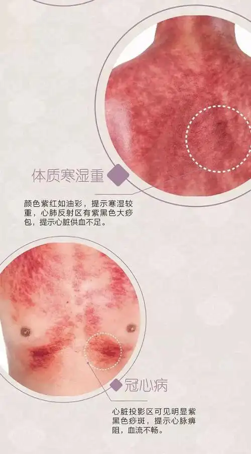 刮拭按压力大,作用深透,速度快,动作重猛,刮痧范围较大,出痧要求色