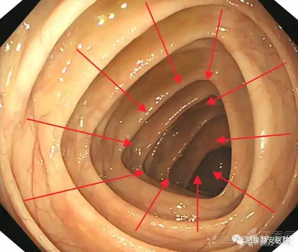 肠镜操作——对于肠腔走向的判断及小思考 丁香园社区