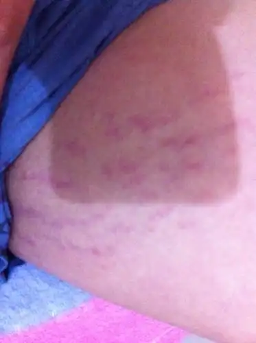 大腿内侧为什么是这样的?不痛不痒的,到底是什么?求大神解答.