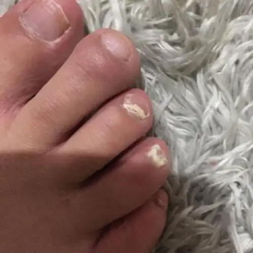 脚趾甲变白什么症状?