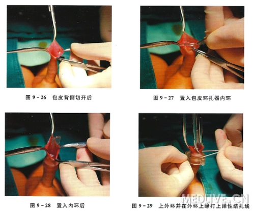 资料全彩图最全面的包皮环切术介绍各种术式