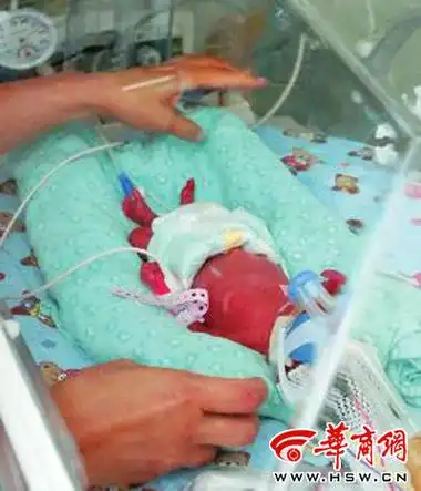 "流产儿"顽强活下来(图)