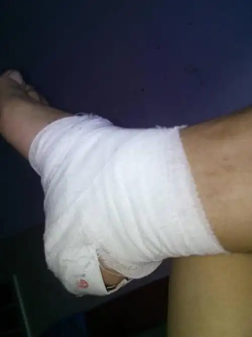 我在上班的时候脚跟被弄到,自己到医院检查,结果是脚跟骨折,医生要求