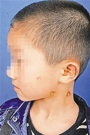 不听话就用烧热的打火机烫脸