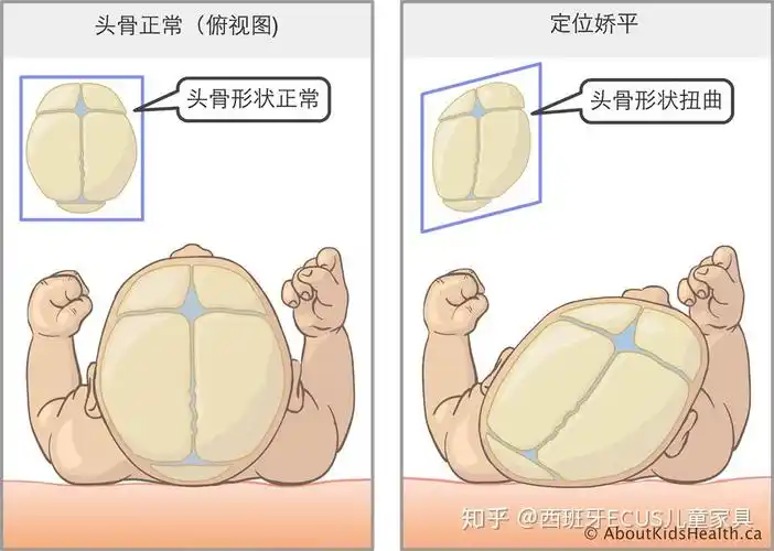 科普斜头畸形的影响flatheadsyndromeplagiocephaly