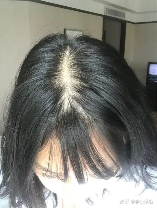 各位女生出现脱发症状后都怎么处理呢?