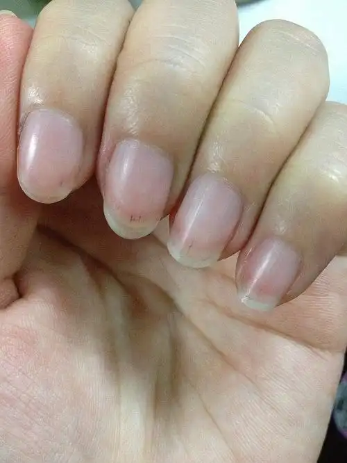 指甲出现小黑线……啥原因啊