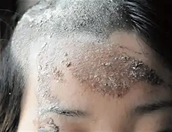 因老家房屋纠纷,赵某姐妹俩被从青岛平度赶来的李某用硫酸泼在脸上