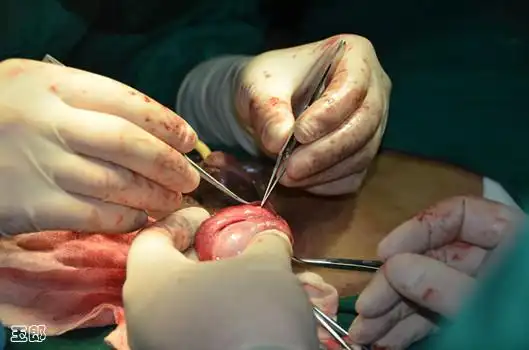 【转载】男女结扎