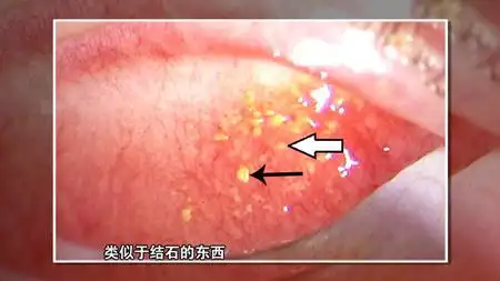 大人小孩纷纷中招眼结石究竟是什么