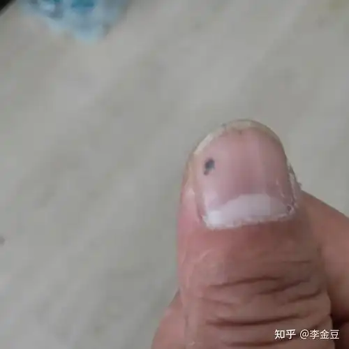 如何判断甲下黑色素瘤? - 知乎