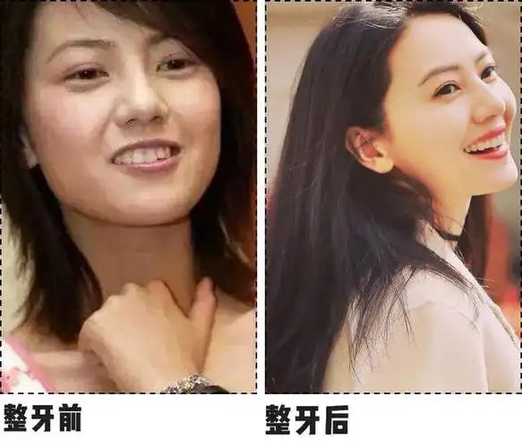 看完这些对比整牙堪比换头是真的
