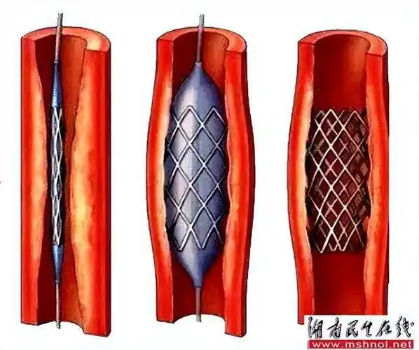 县人民医院神经内科连续完成两例颈内动脉支架植入术_患者_血管_手术