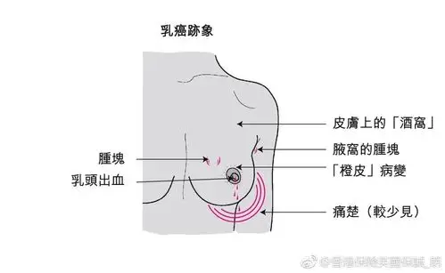 (即乳房出现水肿隆起,毛囊及毛囊孔下陷,看上去像橙皮),皮肤出现酒窝