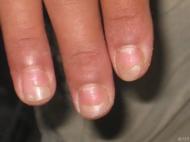 大家帮忙看一下手指甲是怎么了