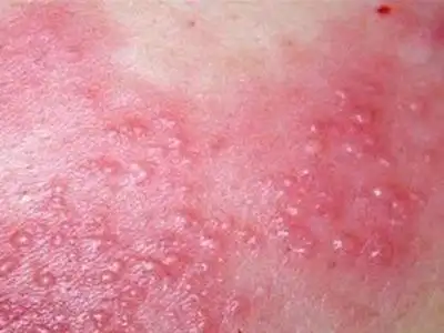 青岛皮肤病医院介绍肛门湿疹要怎么办