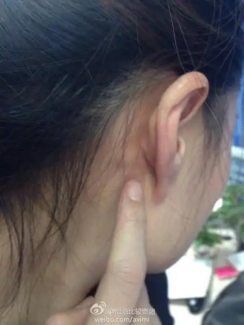 万能的微博耳朵后面这个包包又是啥意思?痛!长两个了.