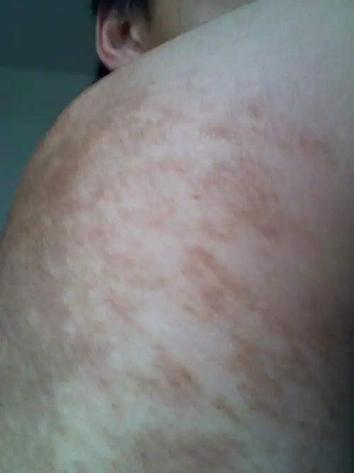 身子背后出现黑斑怎么去除