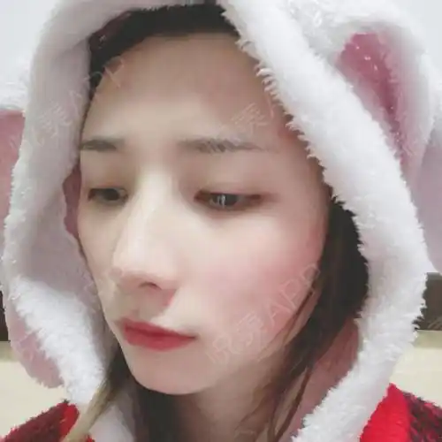 做完鼻子恢复一个月了,差不多已经恢复好了,我每天都.垫鼻尖_悦美整形