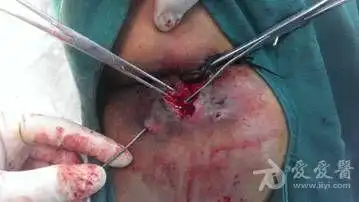 低位复杂性肛瘘一例