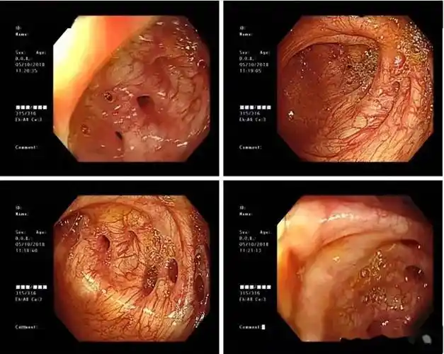 肠道里的"隐形杀手"——结肠憩室病_手术_炎症_疾病