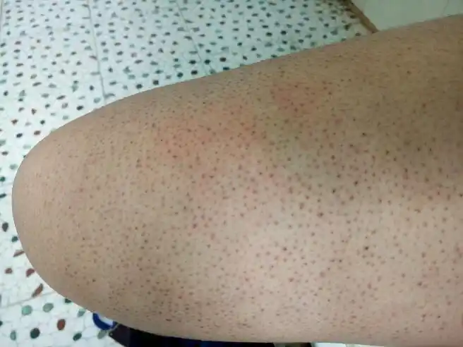 我大腿小腿上有很多小点,长了很多年了没消过,这是什么,怎样去掉?