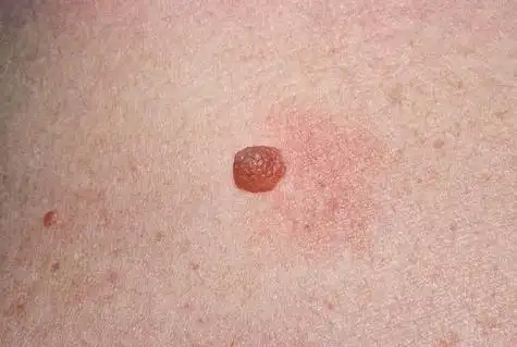 朱砂痣长什么样儿手上的朱砂痣长什么样