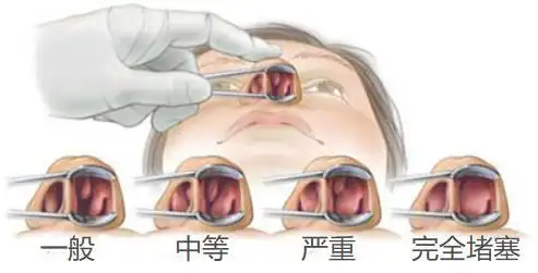 (图源网络,侵权则删)能不能写写鼻甲肥大,小孩最近晚上睡觉鼻塞,早晨