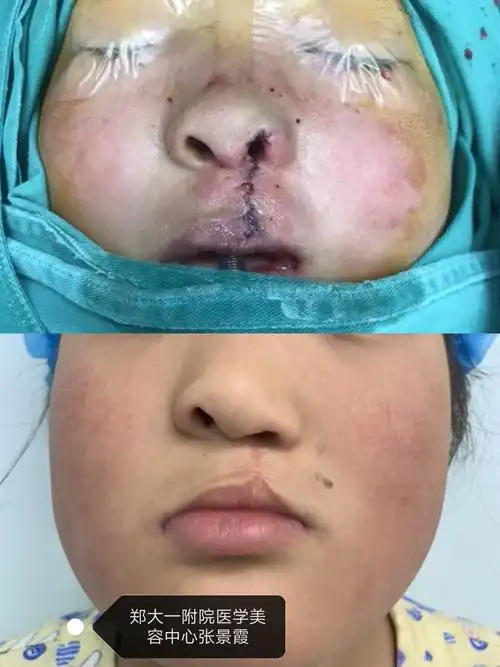 唇裂术后唇鼻畸形矫正案例 - 好大夫在线