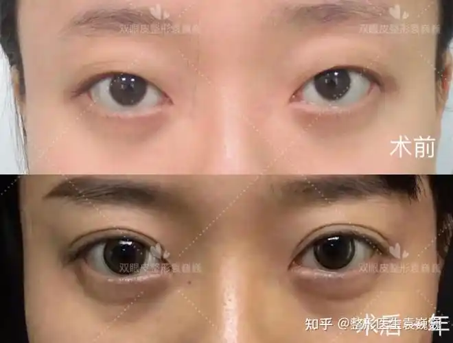 为什么眼球凸的人不建议做宽双眼皮