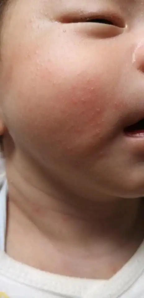 宝宝脸上的疹子是带热了还是奶疹