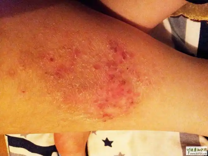 痱子和湿疹的区别肺脏和湿疹有什么区别痱子和湿疹的区别图