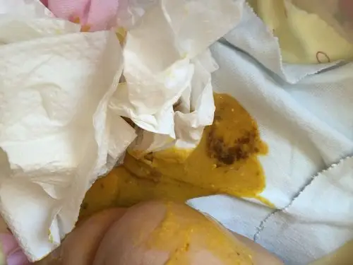 便便里面带深褐色的怎么回事?求指教!