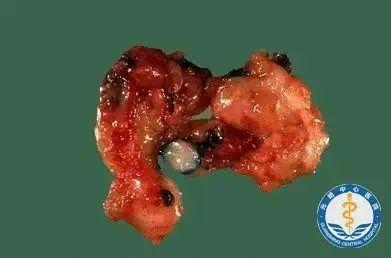 良性肿瘤对机体的影响