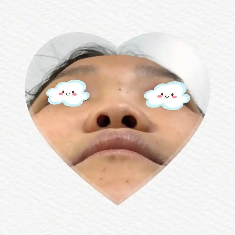 鼻小柱歪斜,鼻孔过圆,鼻小柱高度不足,鼻翼不对称,鼻尖表现点不足