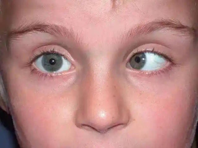 内斜视 斜视1 是指两眼看东西不对称,一眼注视目标,另一眼却偏离