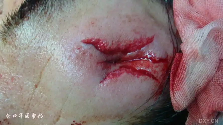 【讨论】很严重的额头外伤 [病例帖]