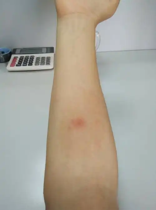 被蚊虫咬了,疙瘩散开成一片了,三四天了还是特别痒,求助怎么治疗?