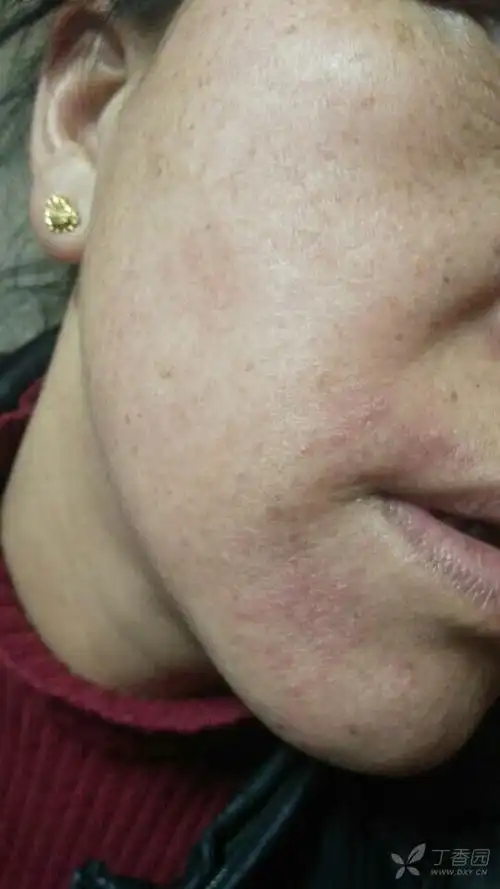 脸部丘疹